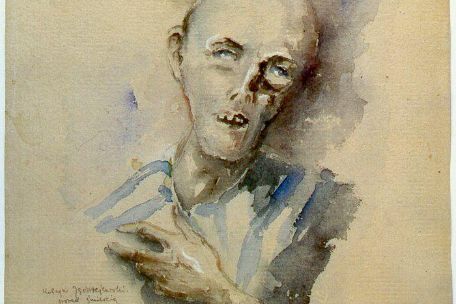A portrait with an extremely emaciated face of a dying man with his eyes going nowhere and his mouth open; one hand is placed on his chest. 